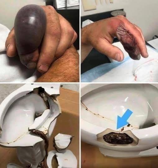 You are currently viewing He Sat Down Like Any Other Day Then Something From The Toilet Changed His Life Forever