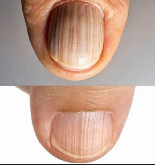 Read more about the article Why You Should Never Ignore These Mysterious Lines On Your Nails Because They Might Be Your Bodys Final Warning About A Serious Hidden Health Condition